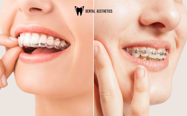 Braces vs Aligners in Lahore