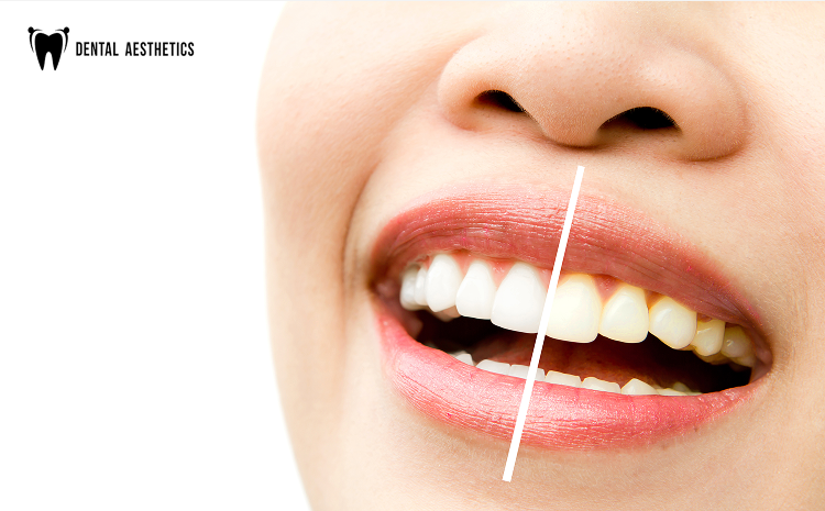 Best Teeth Whitening Services
