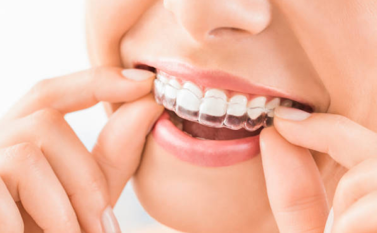 clear-aligners-work