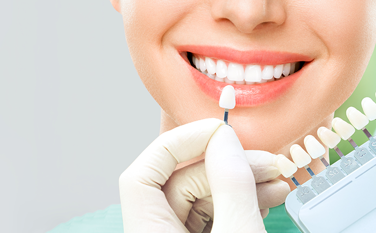 might-need-dental-veneer