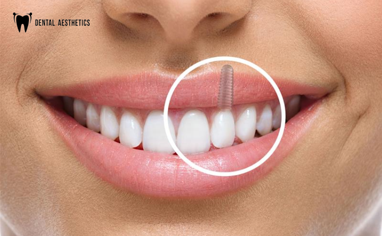 Dental Implants in May 2025