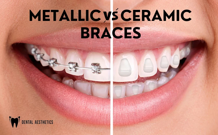 Metal vs. Ceramic Braces in Pakistan: Which Is Right for You?