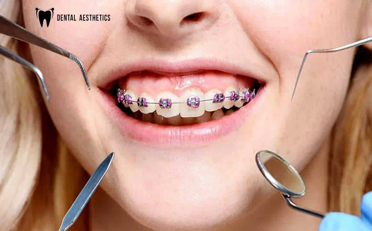 Understanding Stages of Braces Treatment | Expert Insights