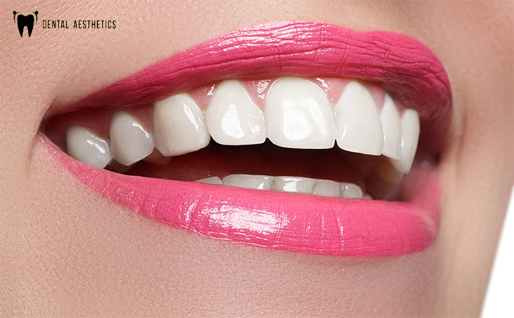 Unveiling the Secrets: Hollywood's Perfect Smile and Veneers