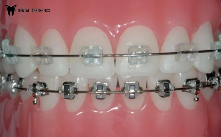 Clear vs Metal Braces: Evaluating the Pros and Cons
