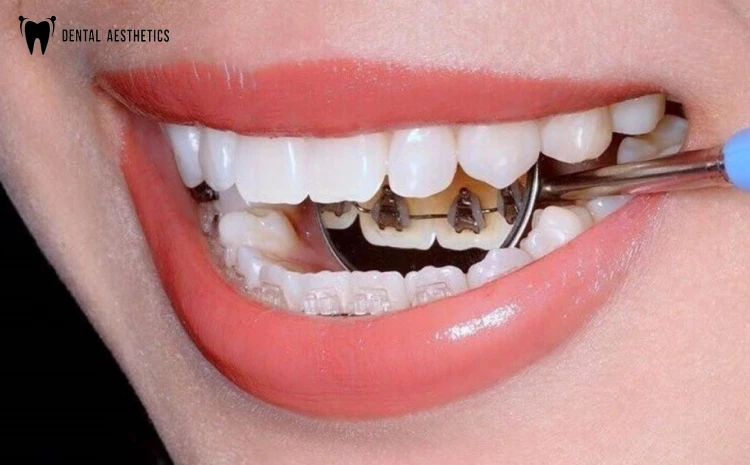 ROOT CANAL TREATMENT - PREVENTION, TREATMENT AND CARE
