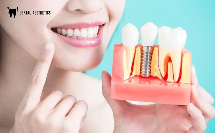 Can Dental Implants Last a Lifetime