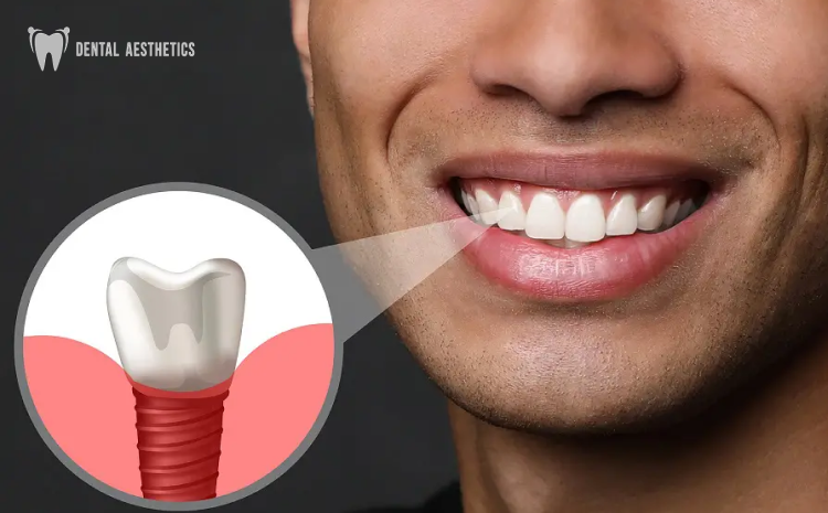 How Do Dental Implants Work