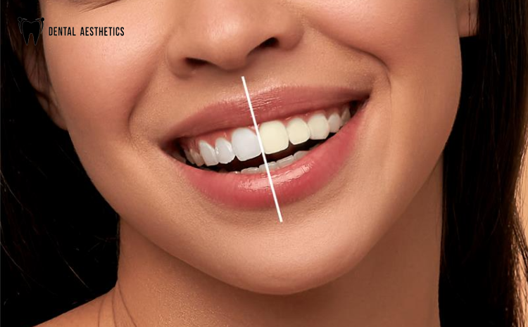 How to Choose the Best Teeth Whitening Clinic in Lahore