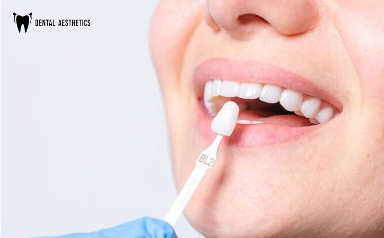How Long Do Dental Veneers Last?