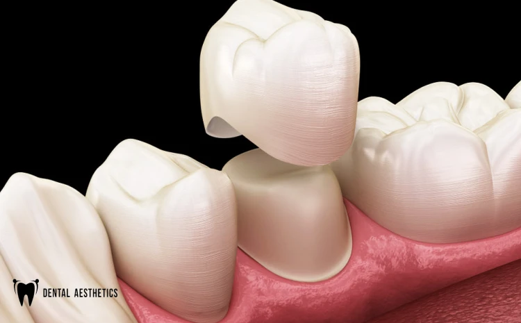Zirconia Teeth Crown Perks, Pitfalls and Pricing in Lahore | Dental Aesthetics