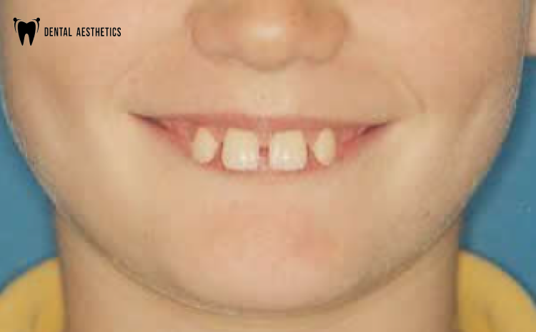 How to Fix Protruding Teeth: Top Treatments for a Perfect Smile