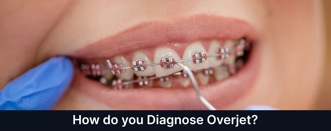 how do you diagnose overjet