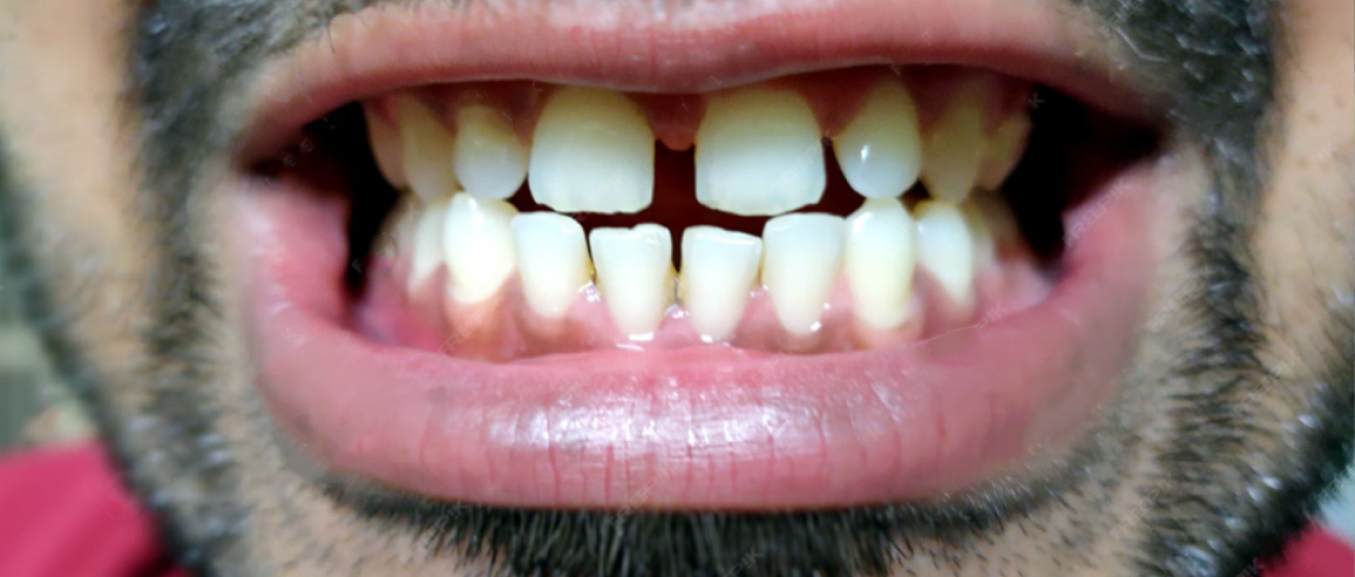 What is Overjet (Buck Teeth)? Causes, Symptoms & Treatment Options