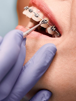 Orthodontic treatment